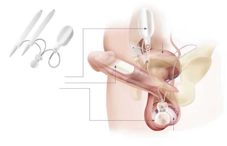 gelové implantáty v penisu