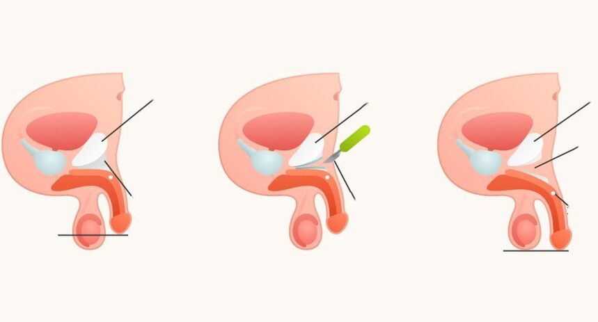 ligamentotomie pro zvětšení penisu